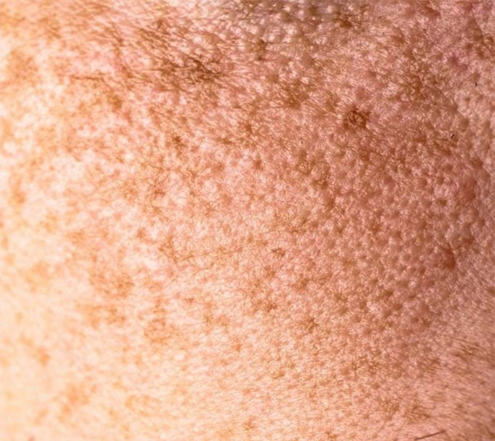 dark spot pigmentation